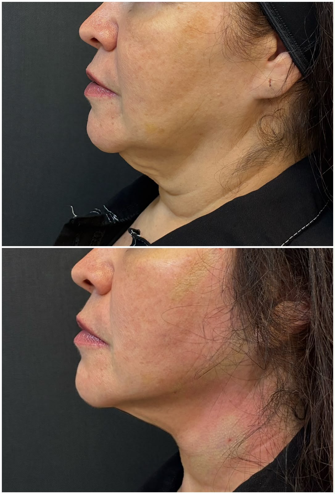 Registro real de antes e depois facial 1