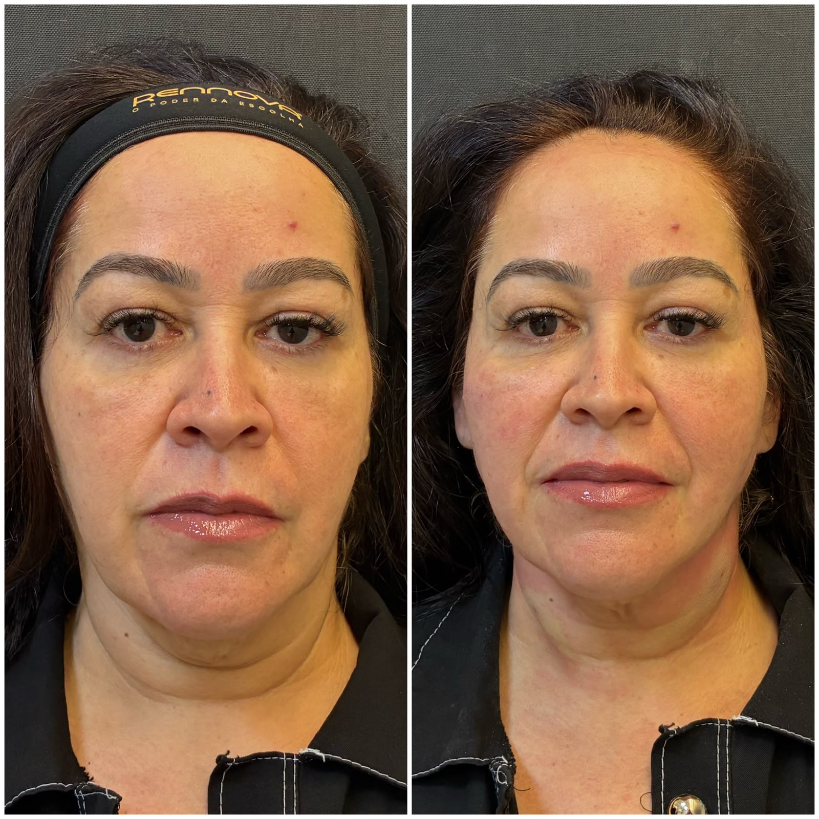 Registro real de antes e depois facial 2