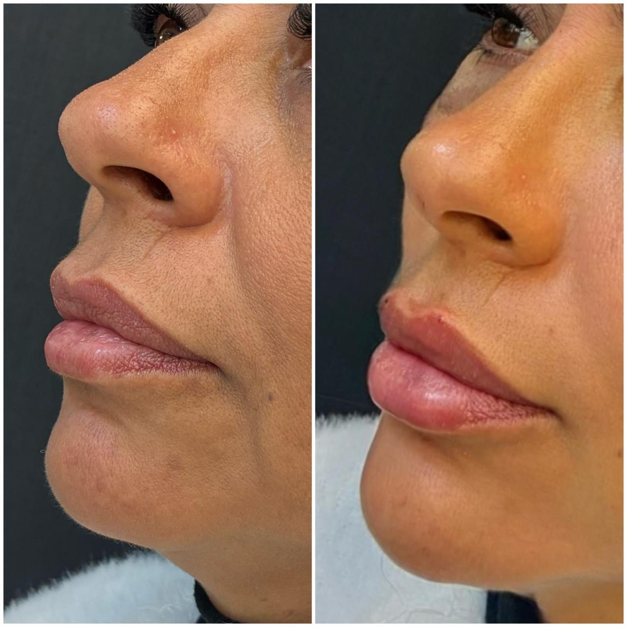 Registro real de antes e depois facial 9