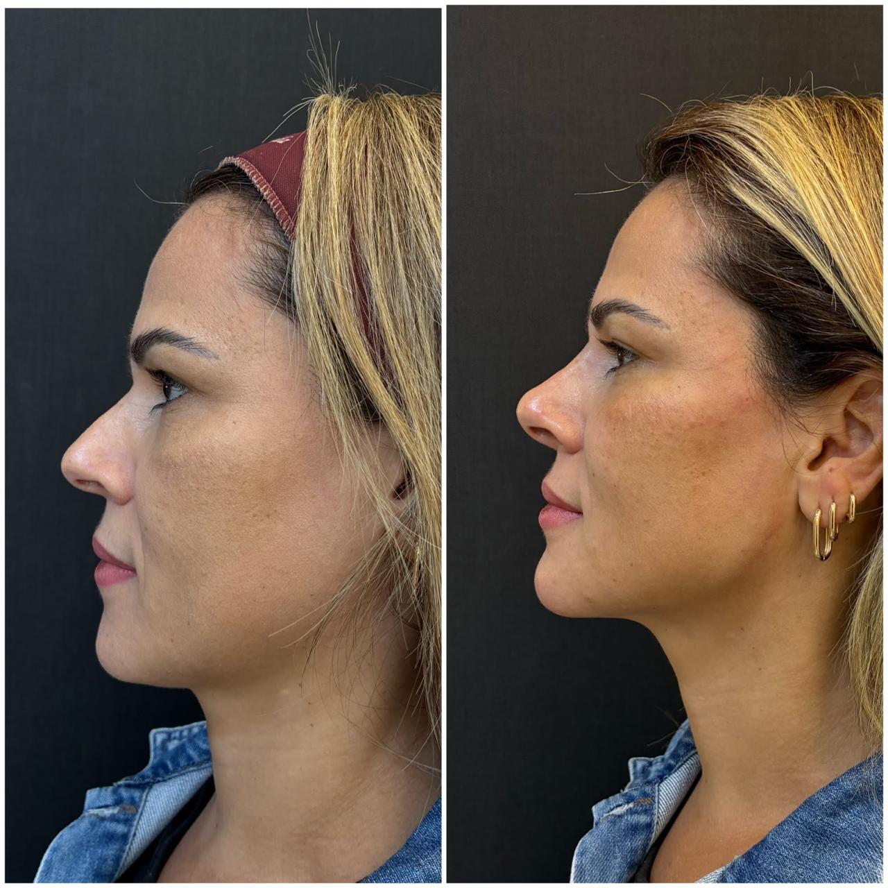 Registro real de antes e depois facial 12