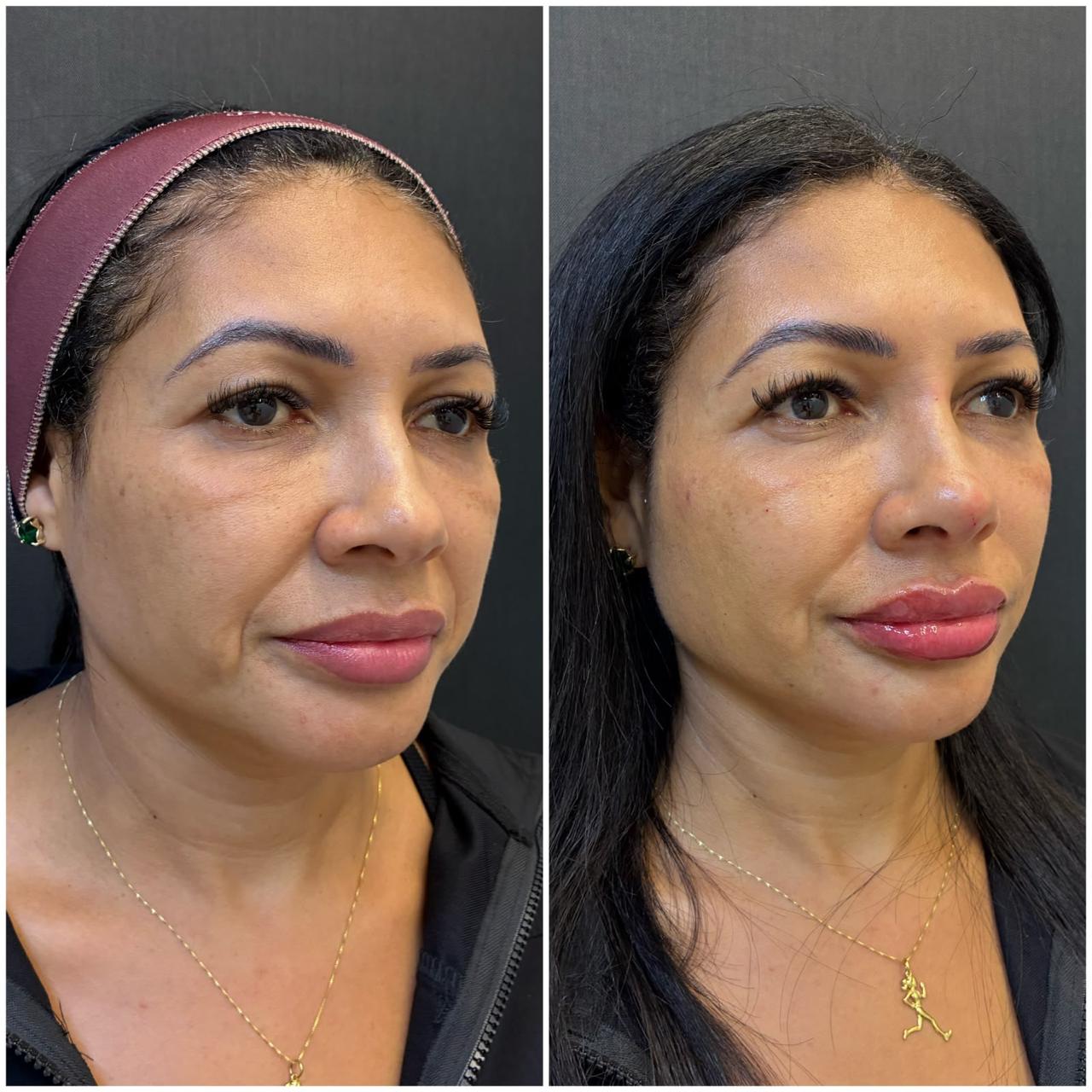 Registro real de antes e depois facial 13