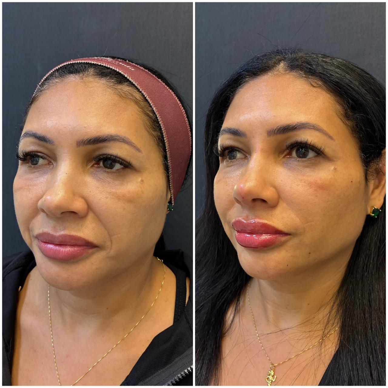 Registro real de antes e depois facial 14